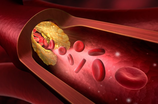 Ischemia cardiaca: quando preannuncia un infarto?