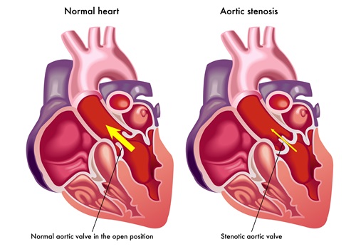 Scompenso cardiaco? Occhio alle valvole