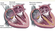 fibrillazione_atriale1.png